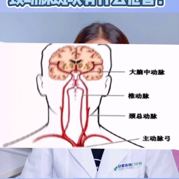 颈动脉斑块