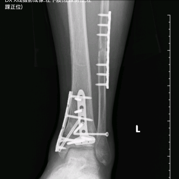 三踝骨折术后康复群 群聊头像